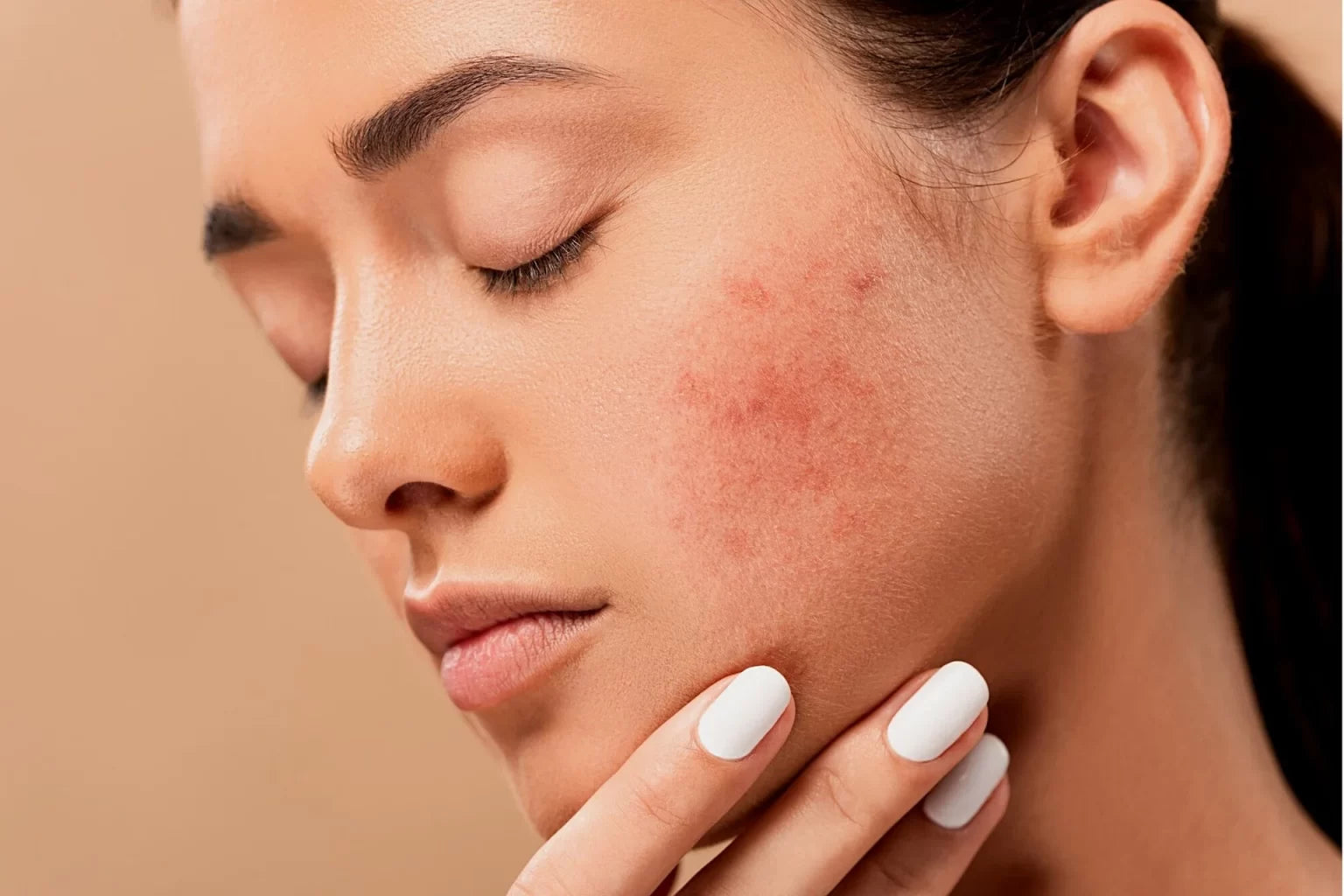 Looking for Solutions to Acne Scars? Expert Advice and Product Recommendations